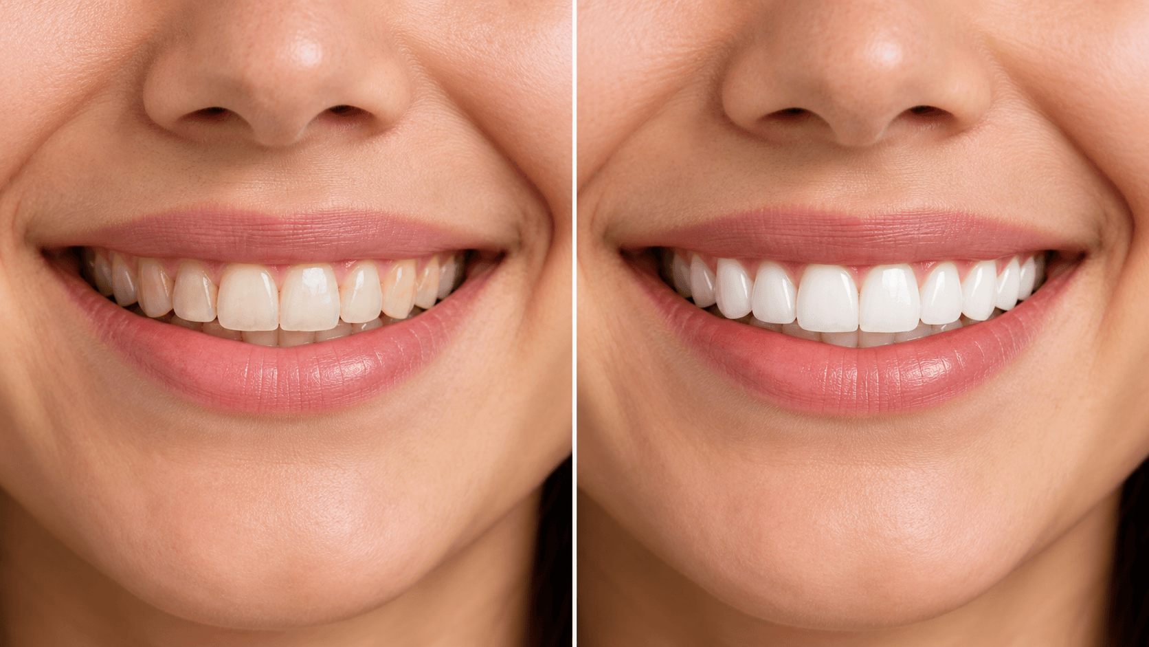 Smile before and after treatment